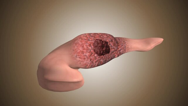 Pancreas affected by cancerous tumor