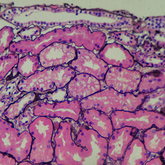 Camera photo of acute tubular injury, showing cytoplasmic vacuolization, Silver stain,...