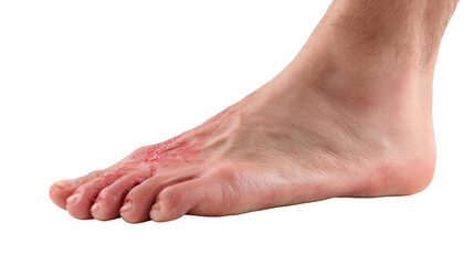 Redness and inflammation are visible on the sole and toes of a person suffering from diabetic foot ulcer, a serious complication of diabetes, isolated on a transparent background
