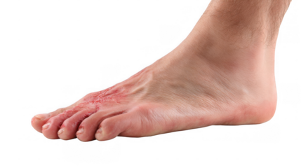Redness and inflammation are visible on the sole and toes of a person suffering from diabetic foot ulcer, a serious complication of diabetes, isolated on a transparent background