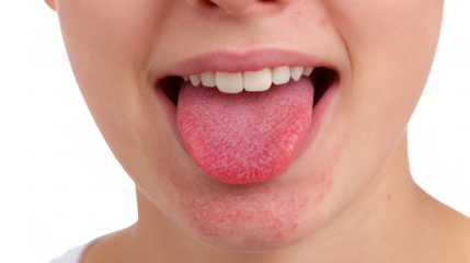 Lower face of a woman sticking out her tongue, displaying a classic red bumpy texture associated with scarlet fever, set against a transparent background for clear visibility