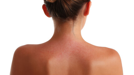 Caucasian woman with sun damaged skin, showcasing redness and irritation from sunburn, emphasizing the critical need for effective sun protection and skincare practices