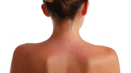 Caucasian woman with sun damaged skin, showcasing redness and irritation from sunburn, emphasizing the critical need for effective sun protection and skincare practices