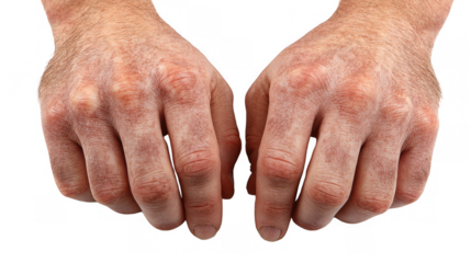 Hyperpigmentation causing darker patches on skin due to increased melanin production from sun exposure, hormonal changes, or inflammation, visible on hands with a transparent background