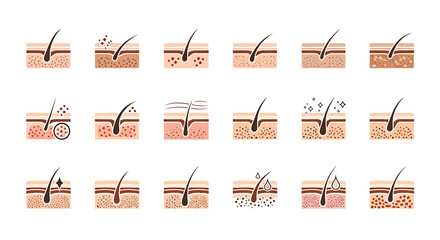 Fototapeta premium Vector Icons Set of Illustrated hair follicle health stages from healthy to damaged with skin layers. Vector Illustrations