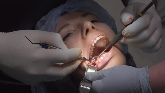 Dental team performs surgical procedure on woman wisdom tooth extraction. Doctors use mouth prop to keep jaw open ensuring clear access to teeth