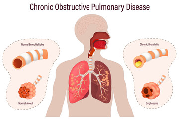Chronic obstructive pulmonary disease (COPD). Comparison between normal bronchus and alveoli with bronchitis and emphysema. Human respiratory system.