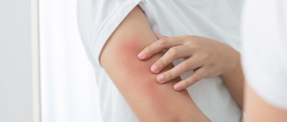 skin problem and beauty. woman scratch body has itchy skin from skin allergic, steroid allergy, sensitive skin, red from sunburn, chemical allergy, rash, insect bites, Seborrheic Dermatitis.