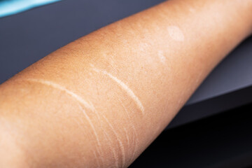 A detailed close up image of a persons arm featuring a noticeable scar on it