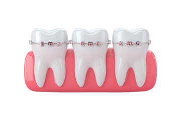 Teeth with dental braces 3d illustration isolated on transparent or white background, png