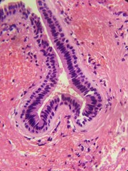 Hidrocystoma pathology 
