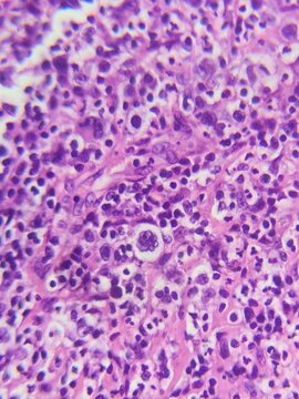 Popcorn cell hodgkin lymphoma 