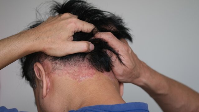 A man who is stressed by psoriasis. Psoriasis on the nape of a man.