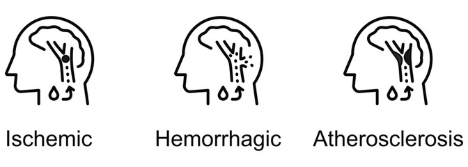 Fototapeta premium Stroke Types banner web icon vector illustration of Ischemic, Hemorrhagic, Atherosclerosis