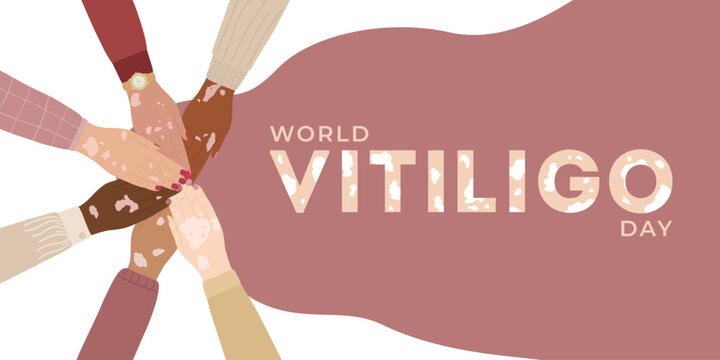World vitiligo day June 25 banner. Diversity hands with vitiligo skin disease stacking together. Body positive concept. Hand drawn vector illustration