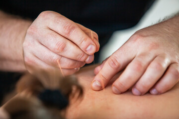 Chinese medicine. Close-up of a doctor's hands doing acupuncture
