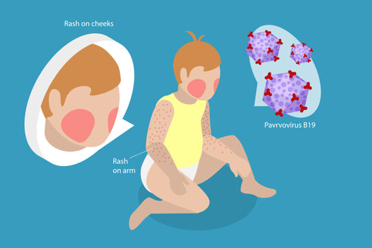 3D Isometric Flat Vector Illustration of Sick Crying Baby, Facial Reaction In Child With Fifth Disease