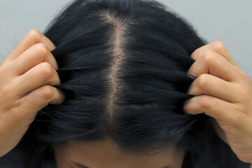 Fototapeta premium Woman with hair loss dryness and frizziness