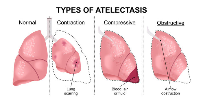 Types of Atelectasis collaped lung illustration
