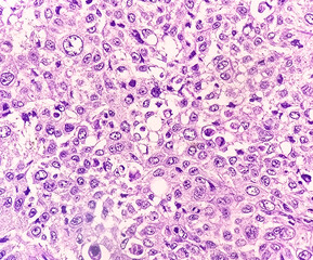 Photomicrographic image showing Metastatic squamous cell carcinoma of a lymph node, a type of skin...