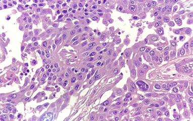 Photomicrographic image showing Metastatic squamous cell carcinoma of a lymph node, a type of skin cancer.