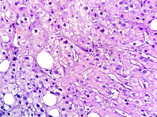 Photomicrograph showing Hepatocellular carcinoma, histology
