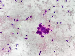 Photomicrograph showing Hepatocellular carcinoma, histology