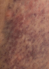 A person's leg has a bruise on it