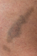 Fototapeta premium A bruise on a person's arm