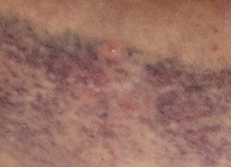 A person has a bruise on their arm