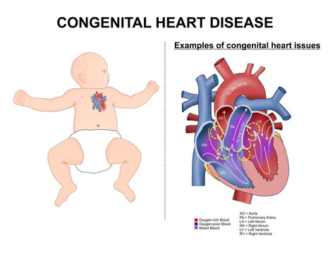 Congenital heart disease in infant