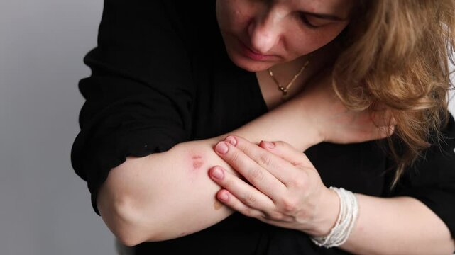 Fresh burn on the arm of a Caucasian female from cooking. 