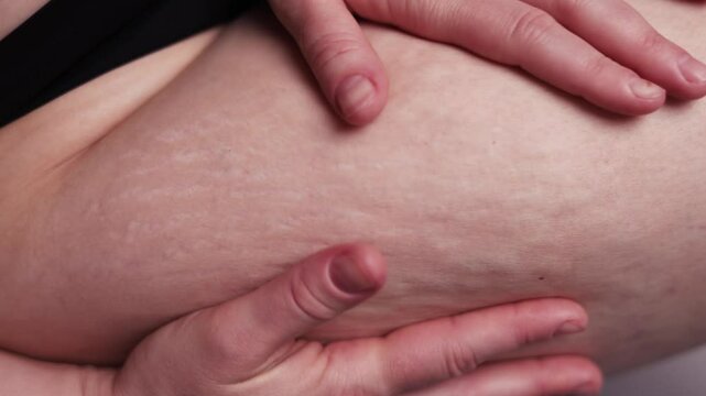 Woman compressing the skin on her legs checking for cellulite and excess subcutaneous fat. A woman showing her stretch marks on her hips. Female thighs with stretch marks on the skin.