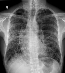 chest X-ray showing the thoracic cavity, including the ribs, spine, and lungs.