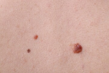 Woman with moles on her body, closeup