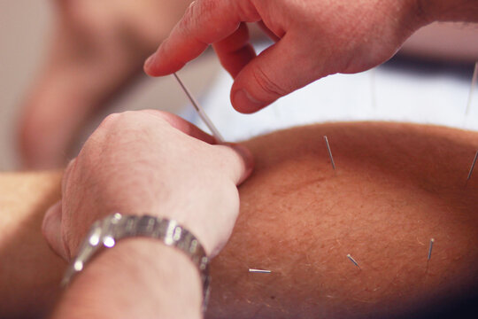 Acupuncture needles being put in a man's leg
