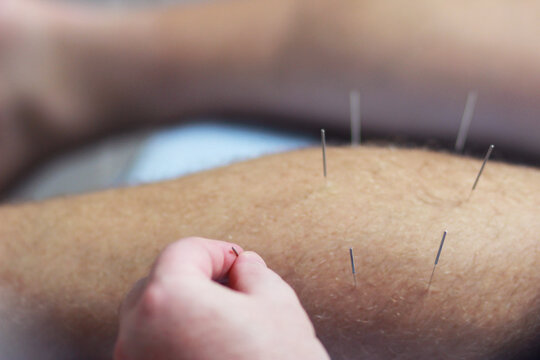 Acupuncture needles being put in a man's leg