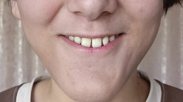 Close-up of the mouth, the smile of a teenage boy. Orthodontic problems. Diastema. The gap between the teeth.