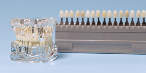 Close-up of a transparent dental implant model with artificial teeth, showcasing metal implants, with a tooth shade guide in the background.