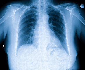 X-Ray Image Of Human Chest for a medical diagnosis