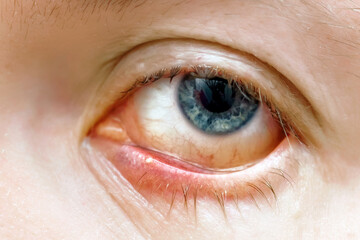 Irritated and swollen eyelid with pus filled pimple, bacterial infection, redness, and discomfort. Tender and inflamed pimple on the eyelid with visible pus, early-stage stye formation.