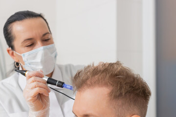 Alopecia. Man hair loss improve growth treatment regeneration, dermapen microneedling, vitamin...