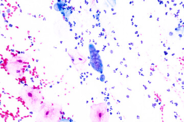 Genital herpes infection by the herpes simplex virus (HSV) of the genitals.Ground glass appearance...