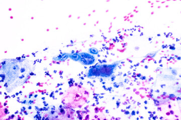 Genital herpes infection by the herpes simplex virus (HSV) of the genitals.Ground glass appearance criteria for pap smear slide cytology and pathology.Human cell medical concept.