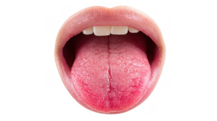Open mouth revealing an inflamed tongue with glossitis, isolated against a transparent background, highlighting various healthcare and medical concepts related to oral health issues