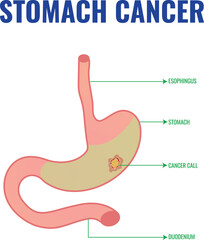 Stomach Cancer Overview Risk Factors and Management