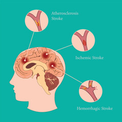 Brain stroke types illustration: atherosclerosis, ischemic, and hemorrhagic stroke overview