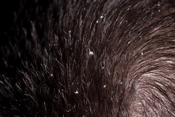 Haircare concept. Dandruff hair. Messy hair. Hair with dandruff. Scalp problem, dandruff and dermatitis or eczema. Problem of dandruff. Hair disease seborrhea.