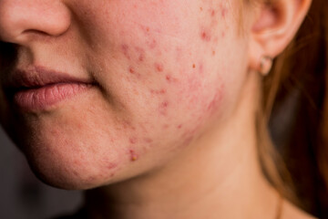 Many pimples. Girl with bad skin. Hormonal acne, puberty. Skin acne background. Closeup acne pimple. Treatment for acne skin. Problem skincare. Pimples, pores, scars. Skincare treatment.