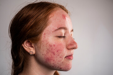 Many pimples. Girl with bad skin. Hormonal acne, puberty. Skin acne background. Closeup acne...